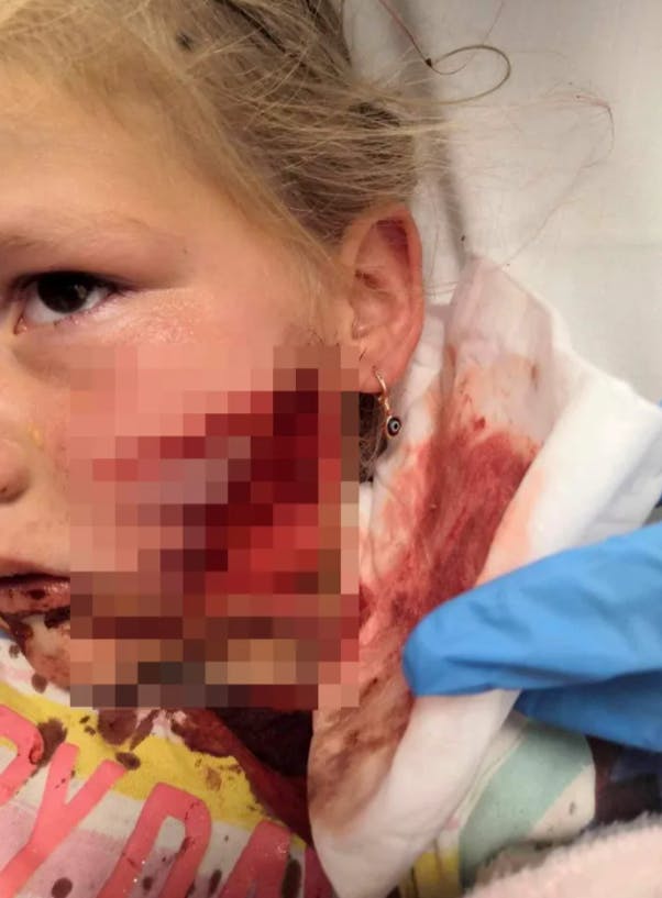 Femårig pige fik grufulde skader i sit ansigt