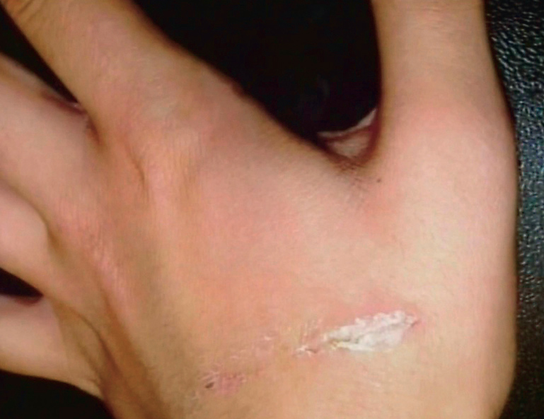 Nouras sår på hænderne