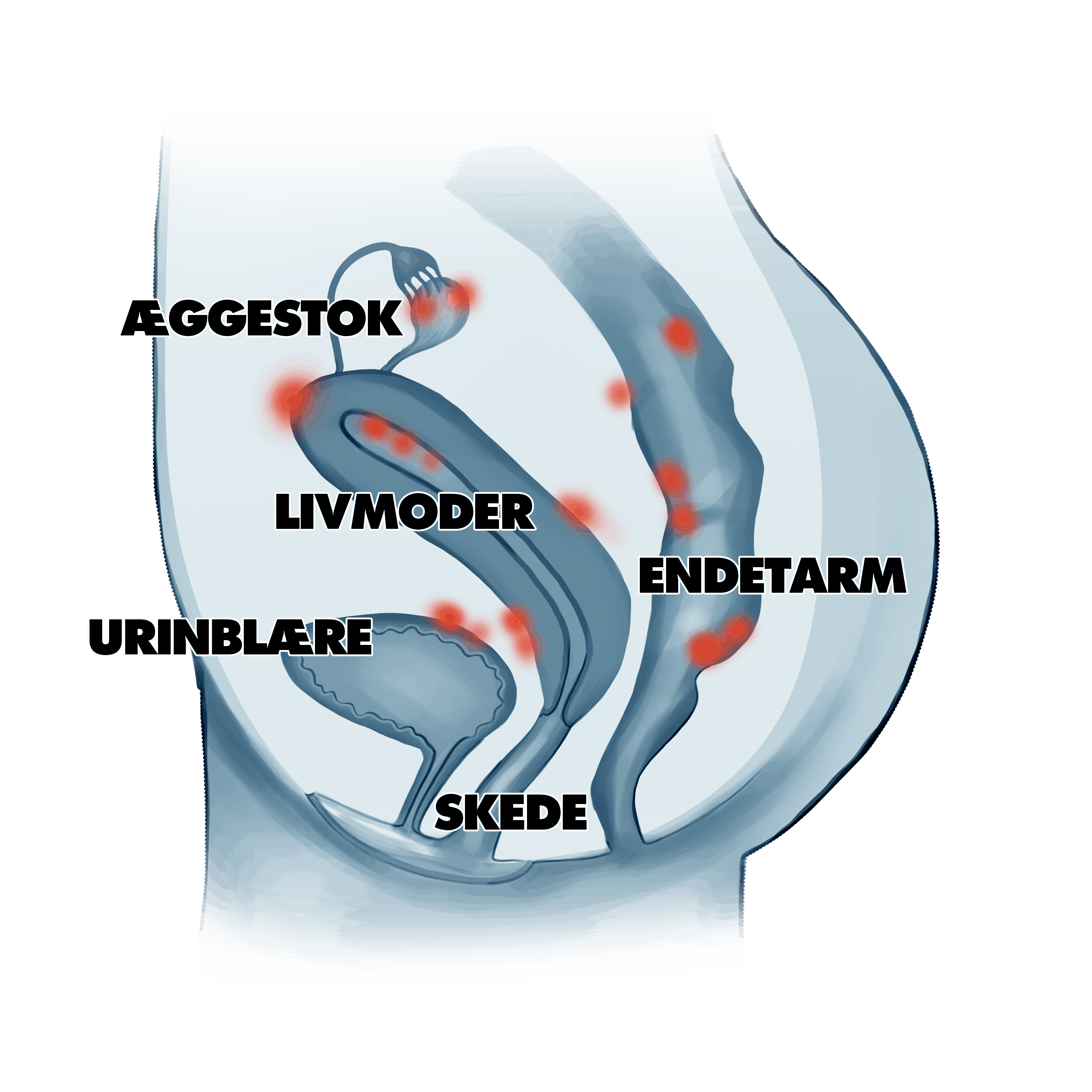 Illustration af endometriose