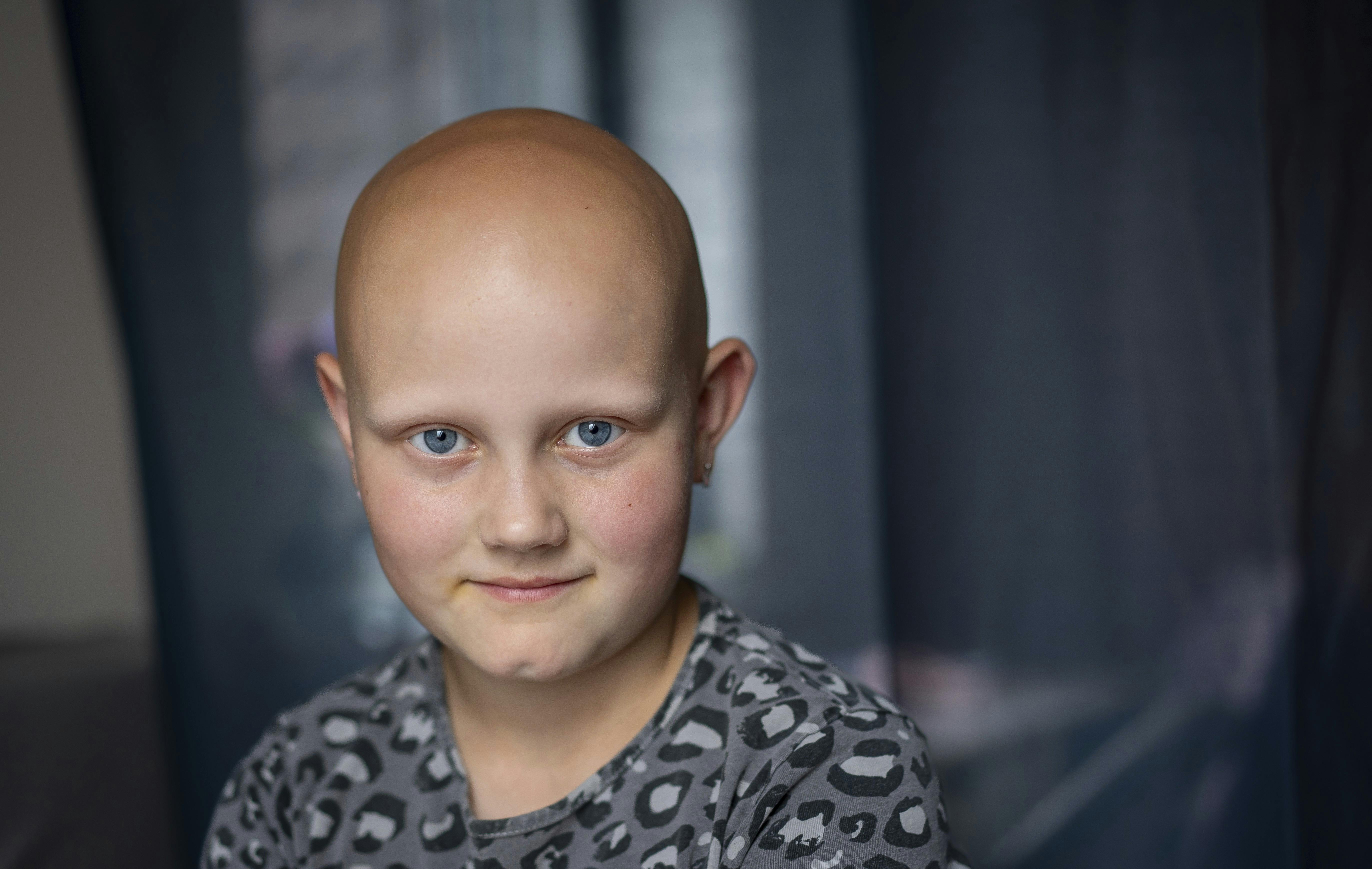 Emmalia på 9 år er ramt af hårtabslidelsen alopecia.