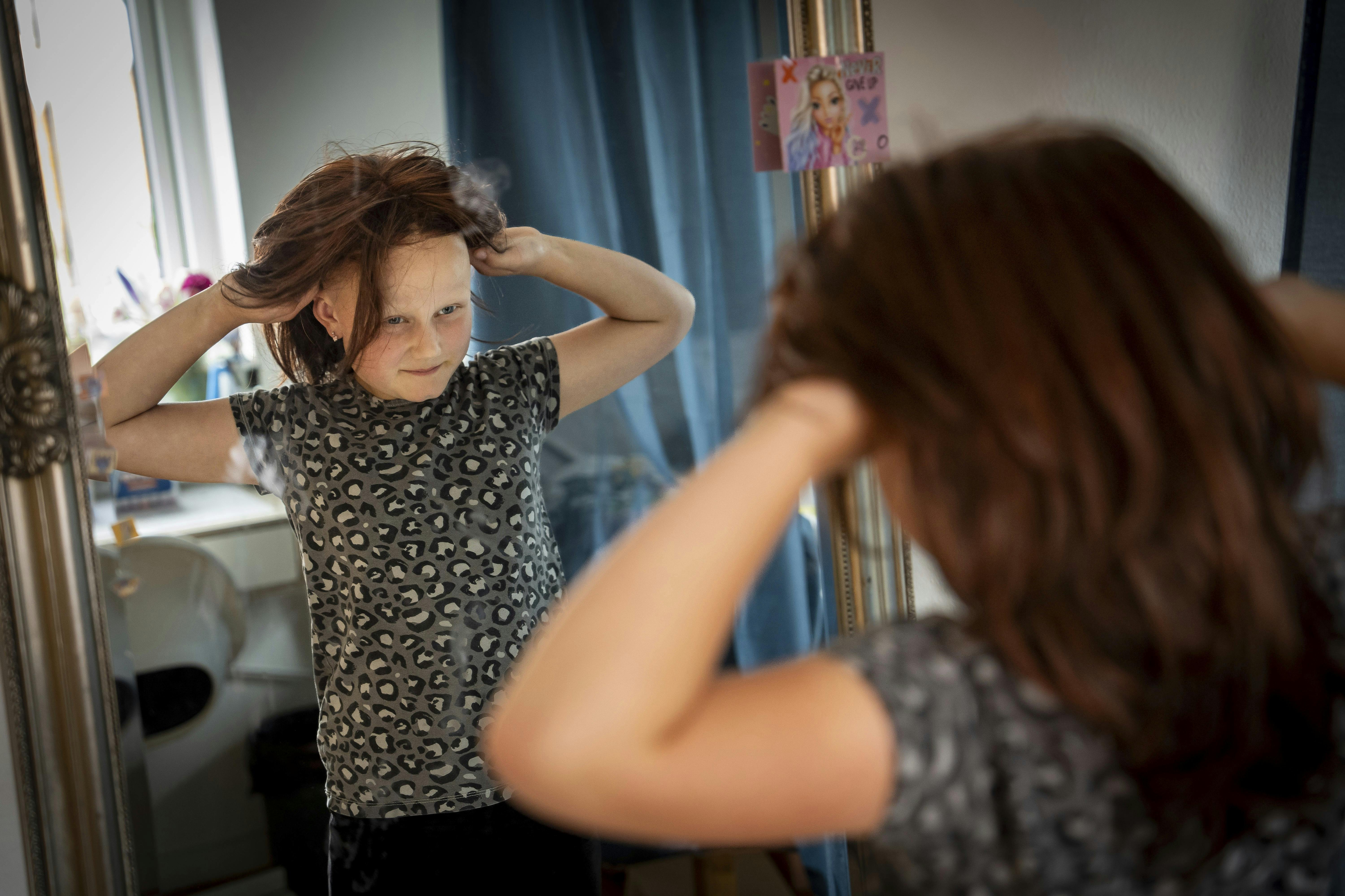 Emmalia på 9 år er ramt af hårtabslidelsen alopecia.