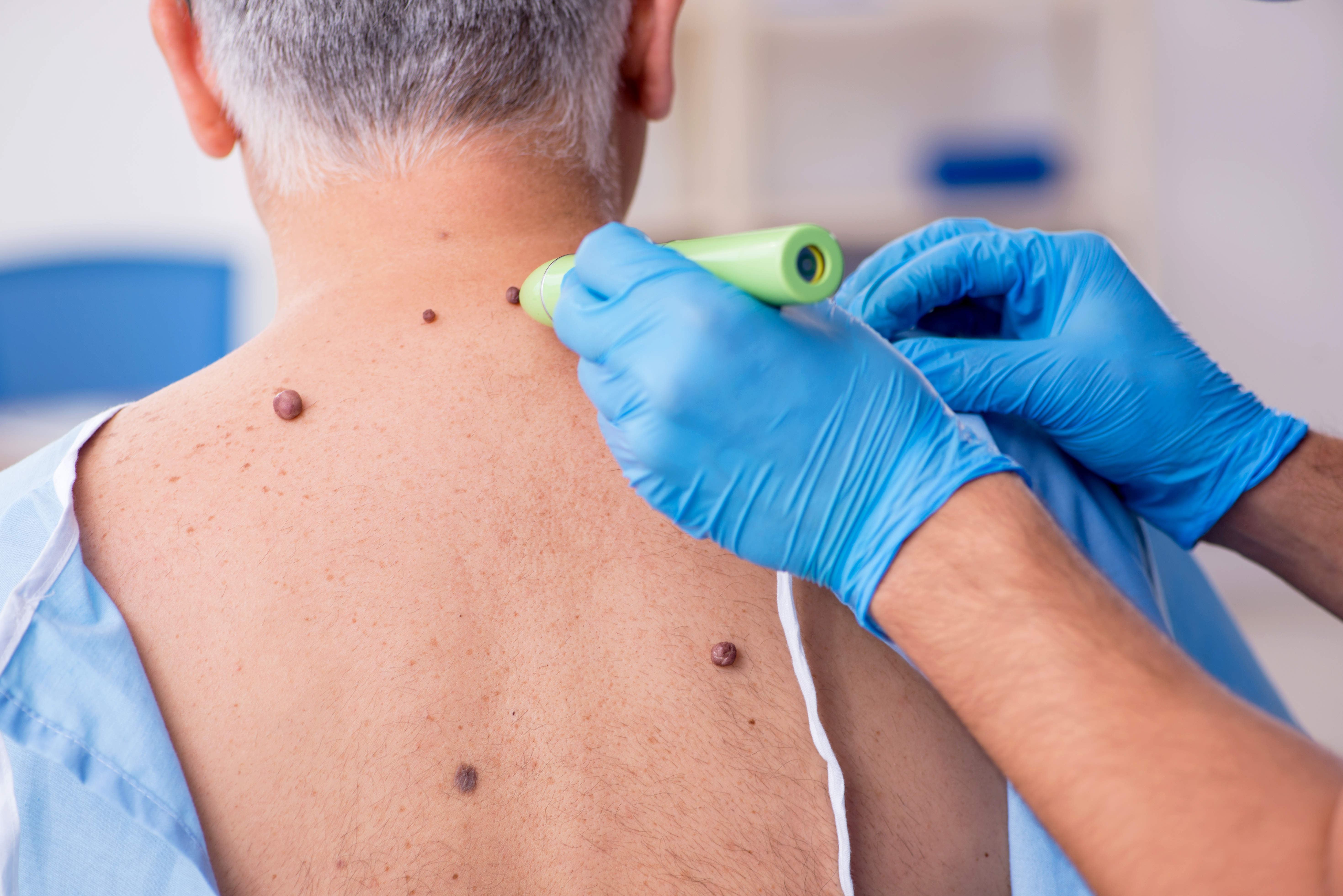 Ældre mand får tjekket modermærker