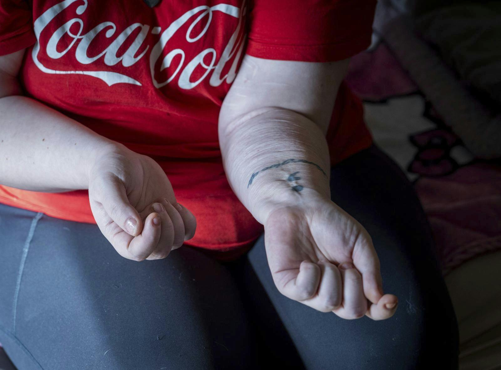 Angela der viser sin tattoo, og hvor hun har skåret i sig selv. 