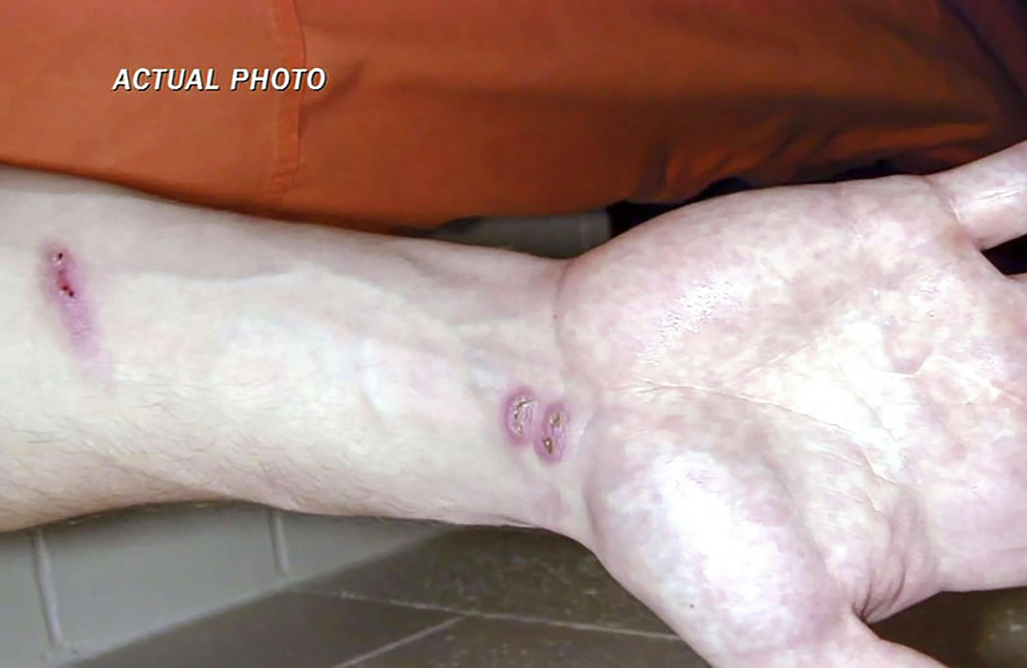 Brændsår på Justin Terpstras arm.