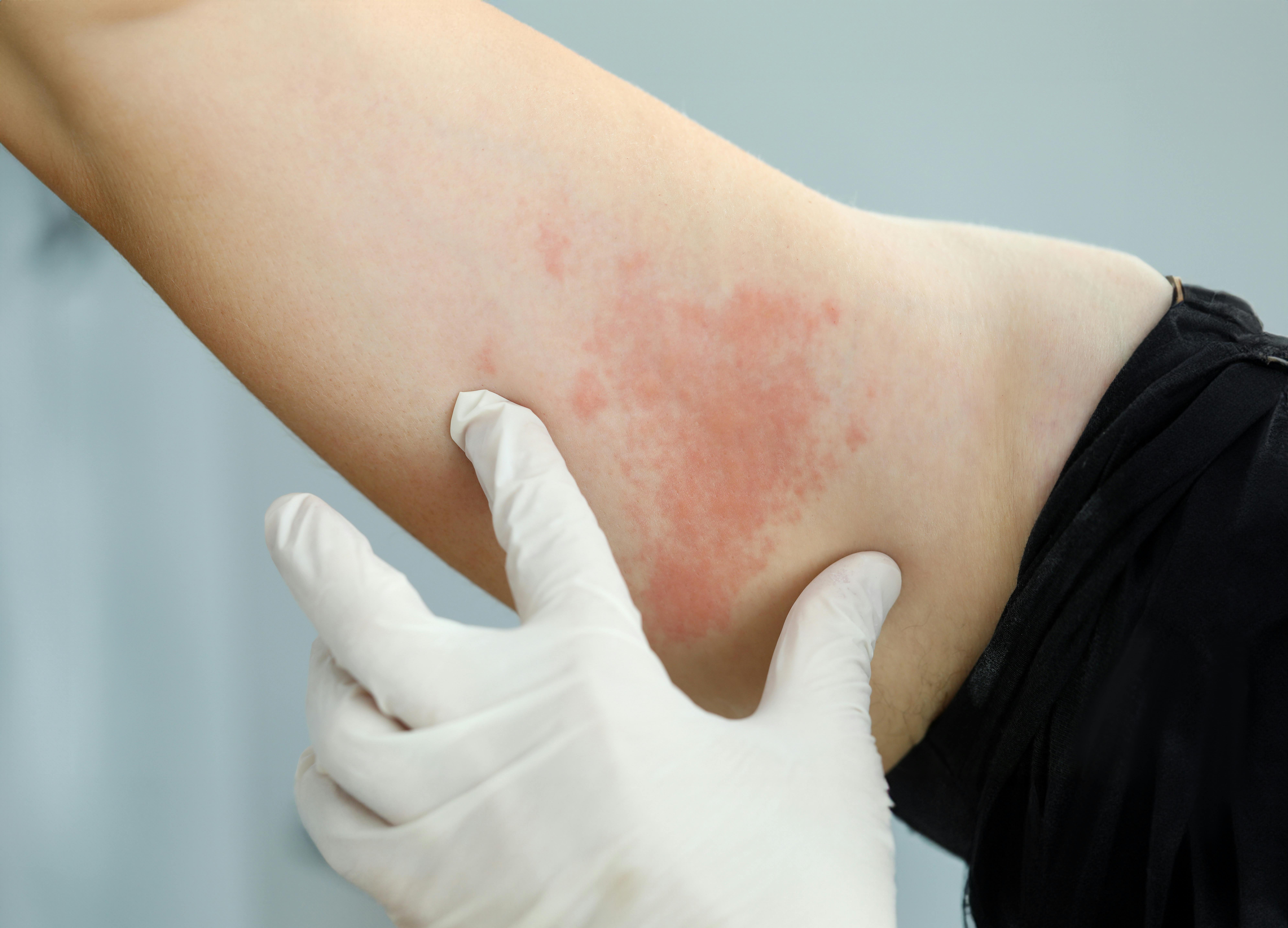 Vaccine mod helvedesild: Læge undersøger patients arm for helvedesild