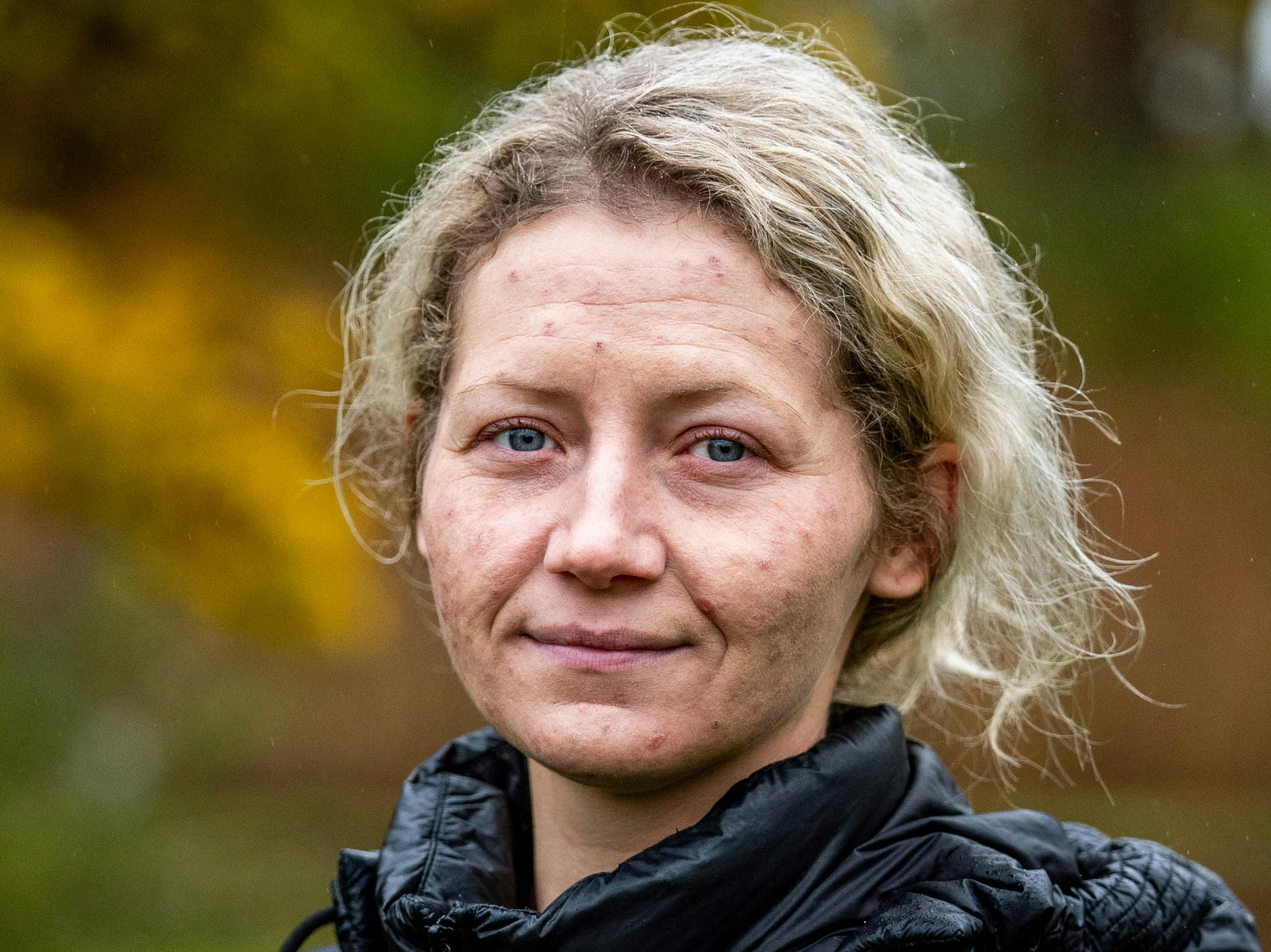 Annie Lund Klochmann Jensen mistede sin 1-årige søn til den sjældne og dødelige Krabbes sygdom