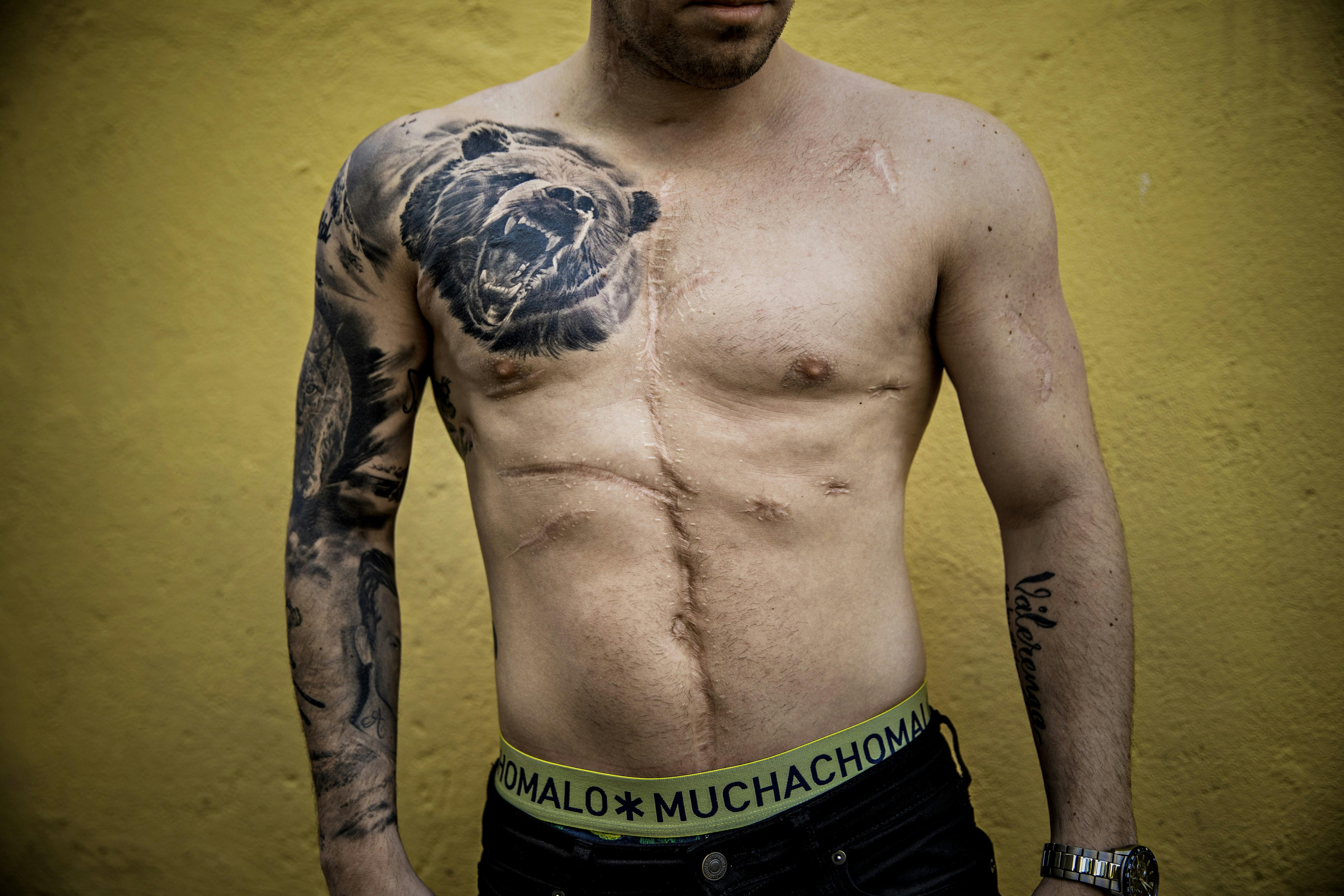 Marius Løkken fik 20 knivstik og overlevede. Her foto af hans krop med ar.