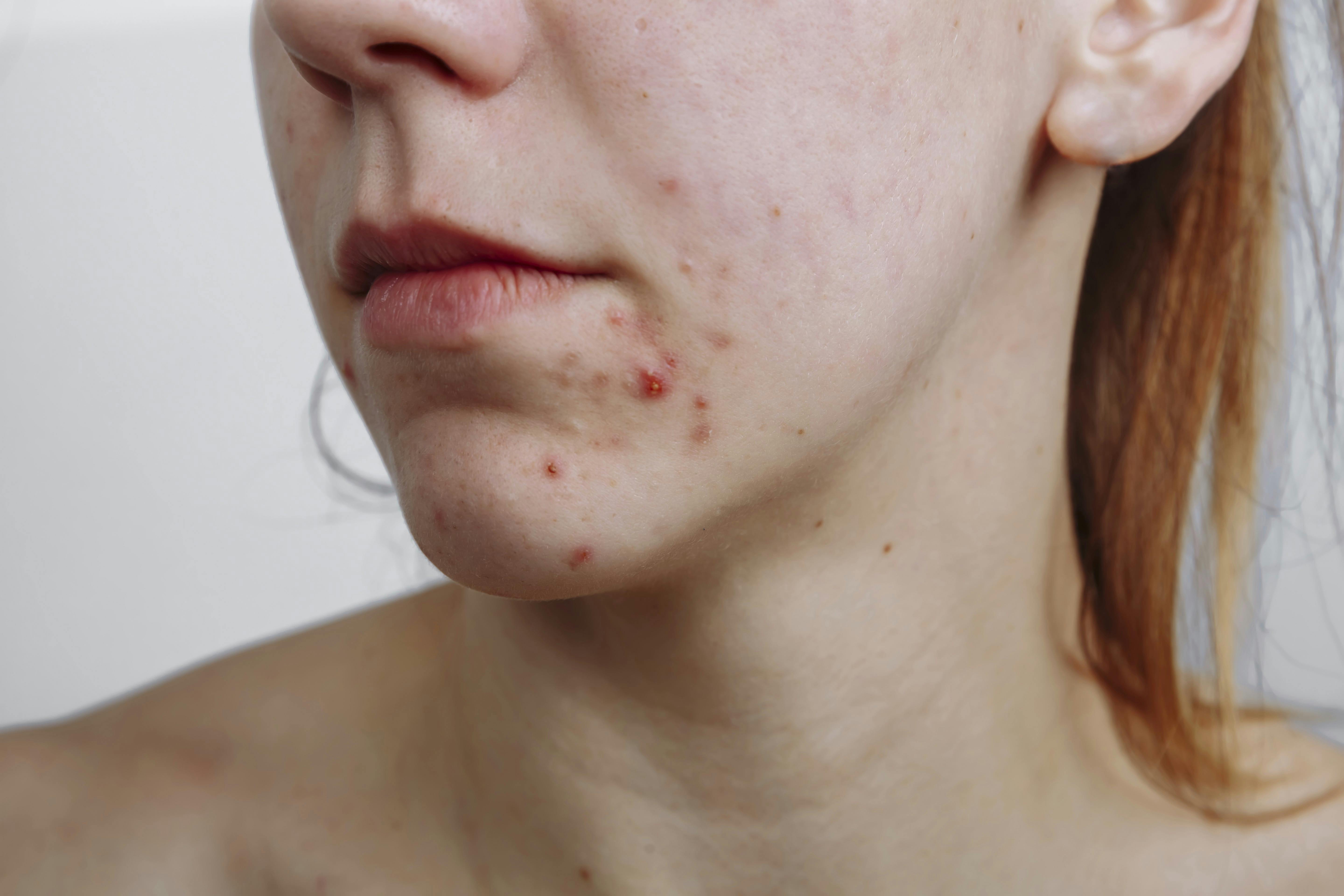 Kvinde med akne – at have akne som ung påvirker ikke ens voksenliv