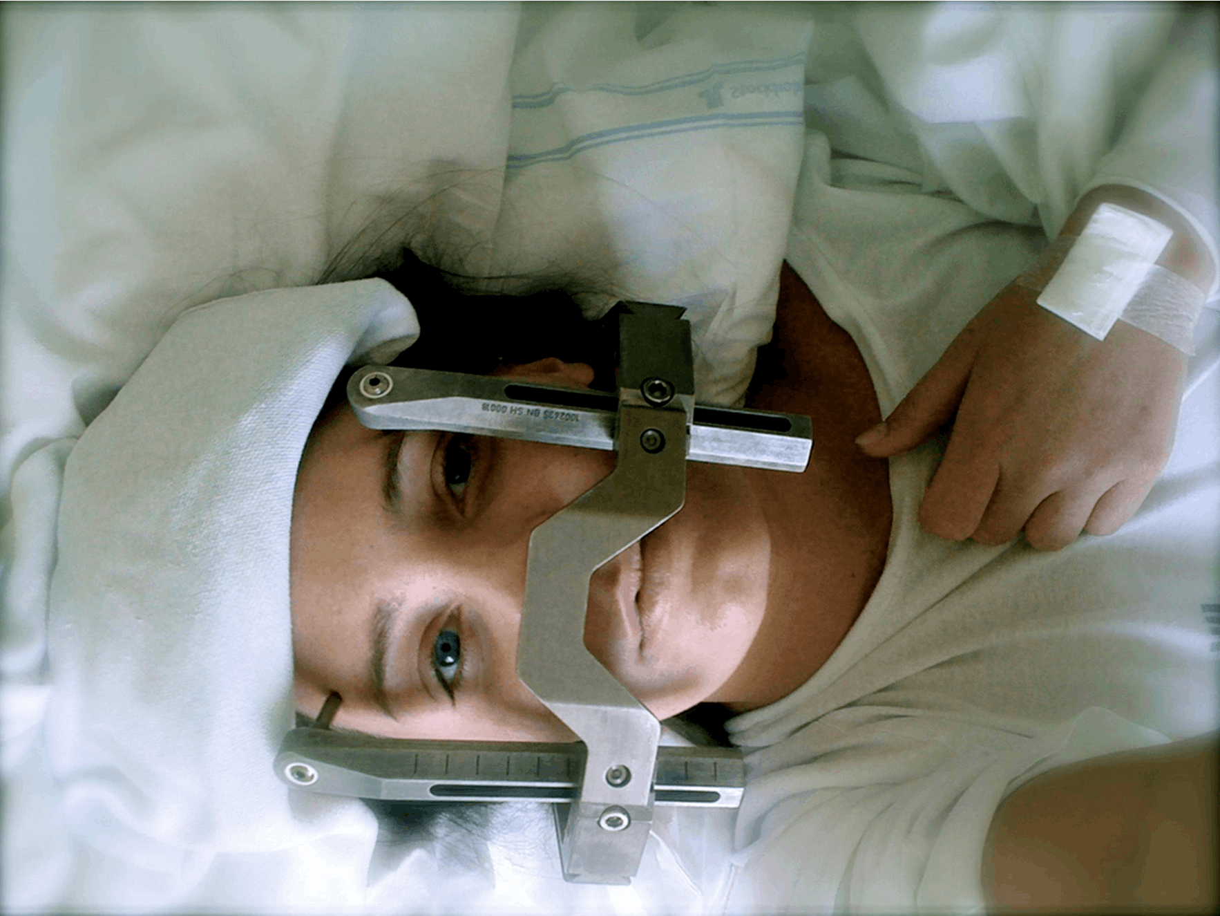 Petra fik skruet et stålstativ fast på kraniet for at holde det helt stille, mens hun blev behandlet med stråling.