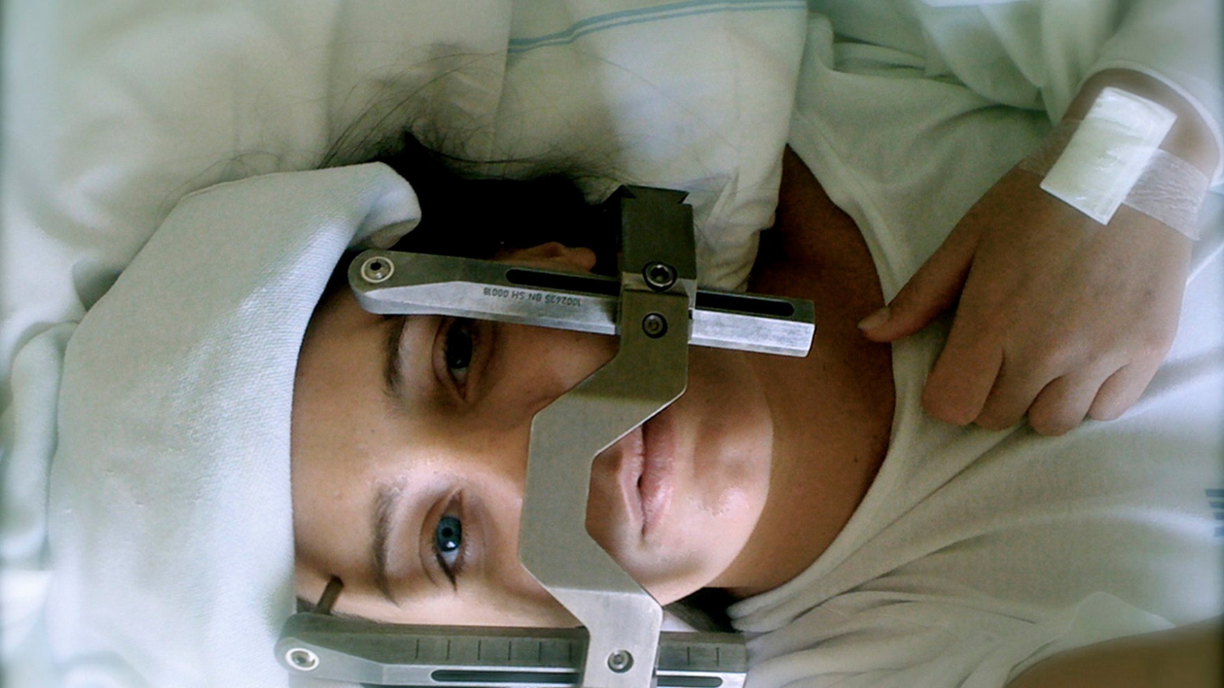 Petra fik skruet et stålstativ fast på kraniet for at holde det helt stille, mens hun blev behandlet med stråling.