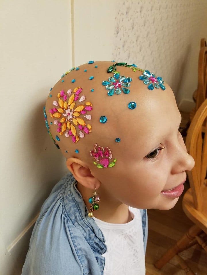 7-årig har alopecia