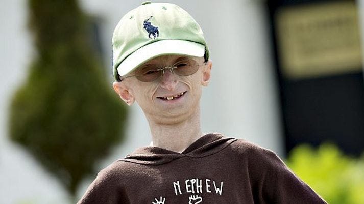 Progeria-ramte Jesper Sørensen fylder 19 år.