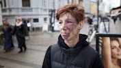 Født med et stort modermærke: Ingen kan elske mig